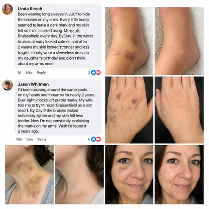 Mirecult® BruiseShield Skin Strengthening Cream Limited-time discount(89K+SOLD)